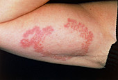 View of an arm affected by granuloma annulare