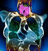 Swollen thyroid gland,MRI scan