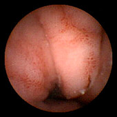 Gastritis,pill camera view