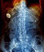 Gallstone,X-ray