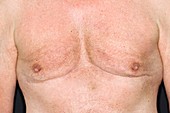 Male breasts after liposuction