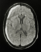 Brain haemorrhage NMR