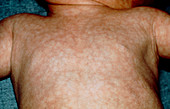 Hypothyroidism: rash on an infant's body