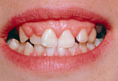 Hyperplasia of gums due to phenytoin