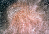 Diffuse alopecia due to hypothyroidism