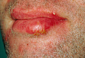 Cold sore (Herpes simplex lesion) on patient's lip