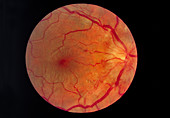 Ophthalmoscopy of the retina in hypertension