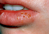 Cold sores due to Herpes simplex type I