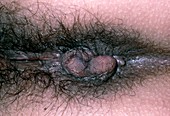 Close-up of prolapsing haemorrhoids (piles)