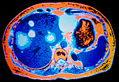 Coloured CT scan showing hydatid disease in liver