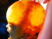 Transillumination of baby's head in hydrocephalus