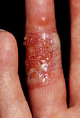 Herpes infection causing blisters on fingers