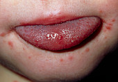 Tongue lesions due to hand,foot & mouth disease