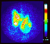 Coloured gamma scan of thyrotoxic hyperplasia