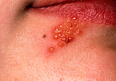 Lip blisters due to the Herpes simplex virus