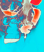 Coloured barium X-ray of an inguinal hernia