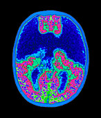 Coloured MRI brain scan showing holoprosencephaly