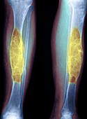 Brown tumours,X-ray