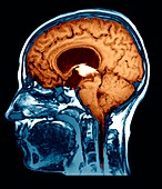 Water on the brain,MRI scan