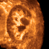 Enlarged kidney,ultrasound scan