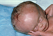 Newborn baby with hydrocephalus