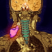 Cystic growth,MRI