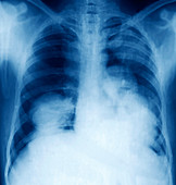 Pulmonary tapeworm cysts,X-ray