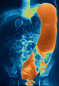 Hirschsprung's disease,X-ray