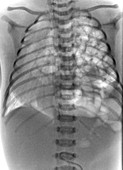 Congenital diaphragmatic hernia,X-ray