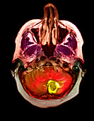 Haemangioblastoma brain tumour,MRI scan