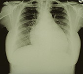 Chest x-ray showing left ventricular hypertrophy
