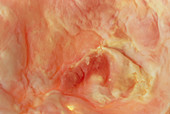 Macrophoto of atheroma plaque in human aorta