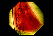 False-colour coronary angiogram: stenosis