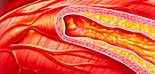 Illustration of coronary artery atherosclerosis