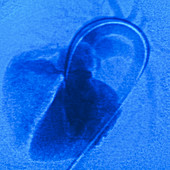 Angiogram of a ventricular septal defect