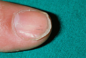 Splinter haemorrhage on fingernail in endocarditis