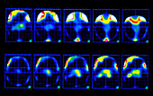 Colour PET brain scans showing pain during angina