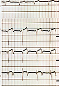 Heart attack: ECG showing myocardial infarction