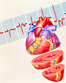 Artwork of heart & ECG trace in heart failure