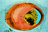 Colour SEM of atherosclerosis in coronary artery