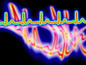 Heart disease: artwork of an irregular ECG trace