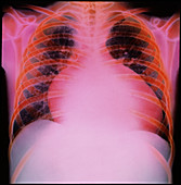 Cardiomyopathy,chest X-ray