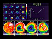 Heart tests after heart attack