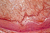 Atheroma plaque,light micrograph