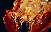 Heart valve disorder