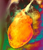 Heart inflammation,X-ray