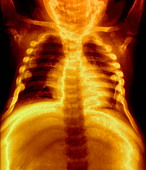 Fallot's tetralogy,X-ray