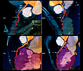 Coronary stent,CT scan