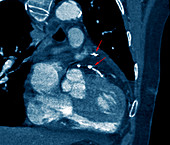 Heart bypass grafts,CT scan