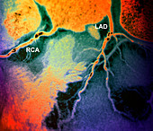 Narrowed coronary artries,CT scan